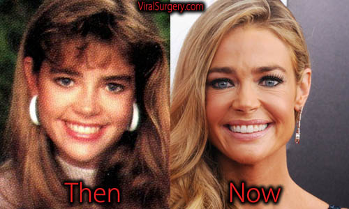 10 Denise Richards' Cosmetic Surgery Secrets Unveiled