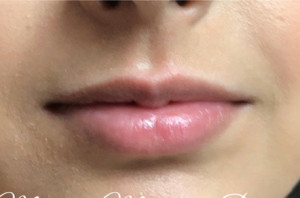 Chase Stokes Lip Fillers