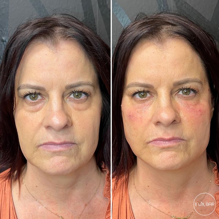 Contour Lift In Minutes Pdo Thread Lift Miracupdothreads Our Patient Was Stressed About The Signs Of Aging Creeping Up On Her She Wanted To Look Youthful Sculpted And Refreshed After