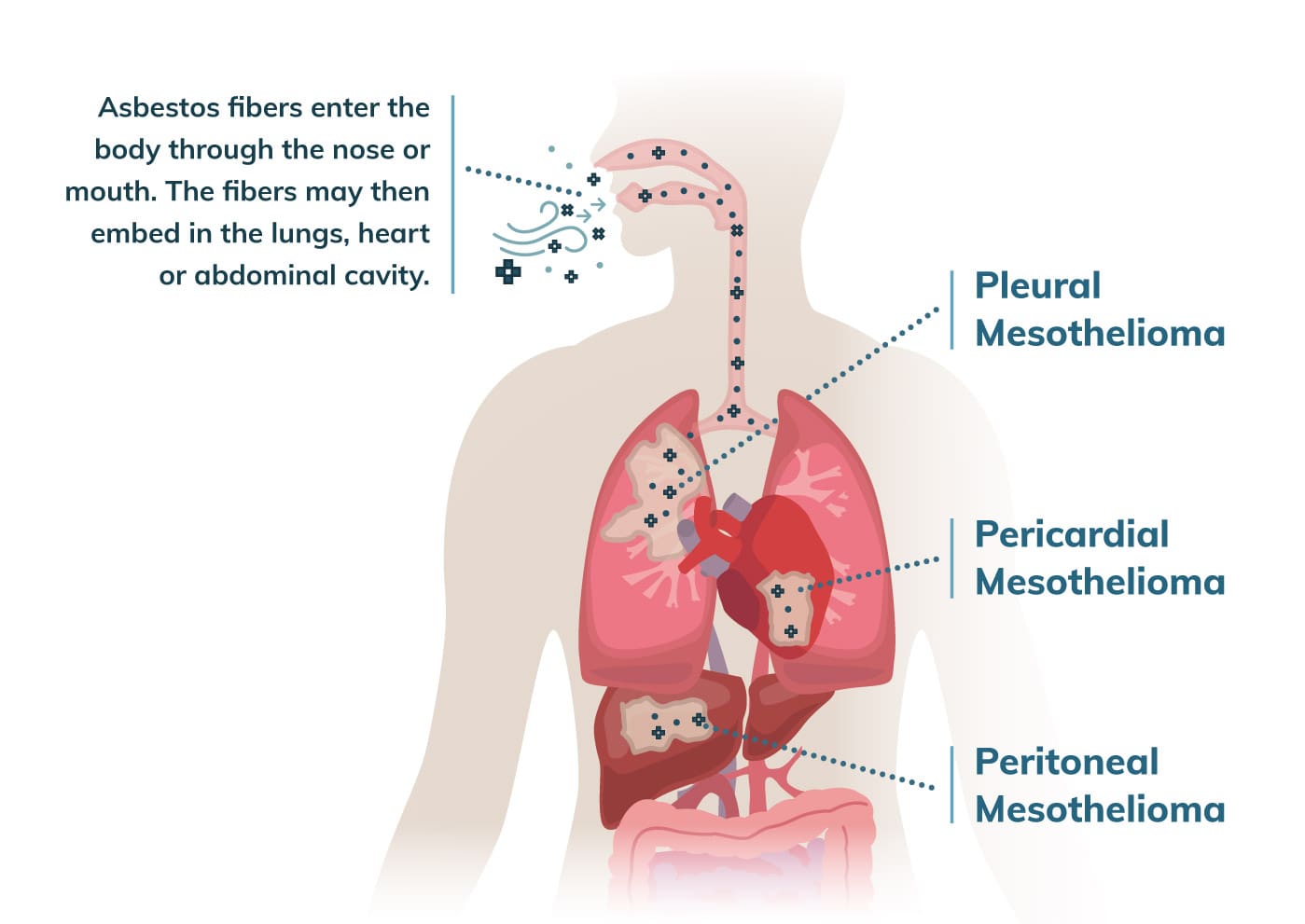 How To Choose A Mesothelioma Lawyer Mesothelioma Feed