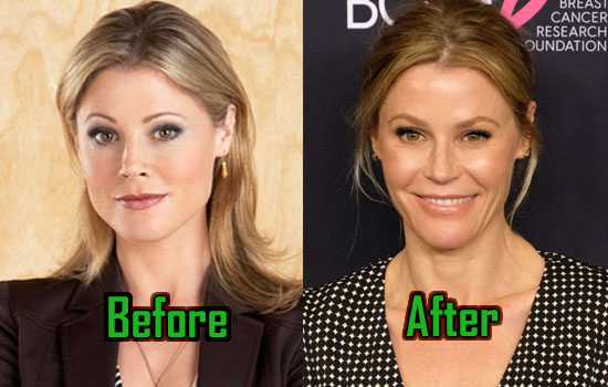 Julie Bowen Before And After Plastic Surgery 03 Celebrity Plastic