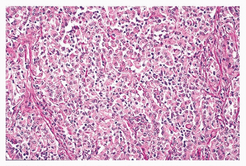 Mesothelioma Basicmedical Key