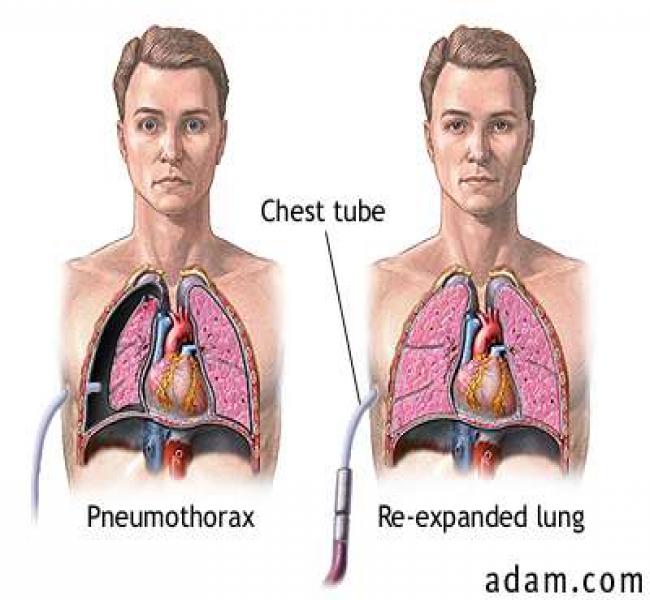 Mesothelioma Claims: A Lawyer's Support For Pearland Residents