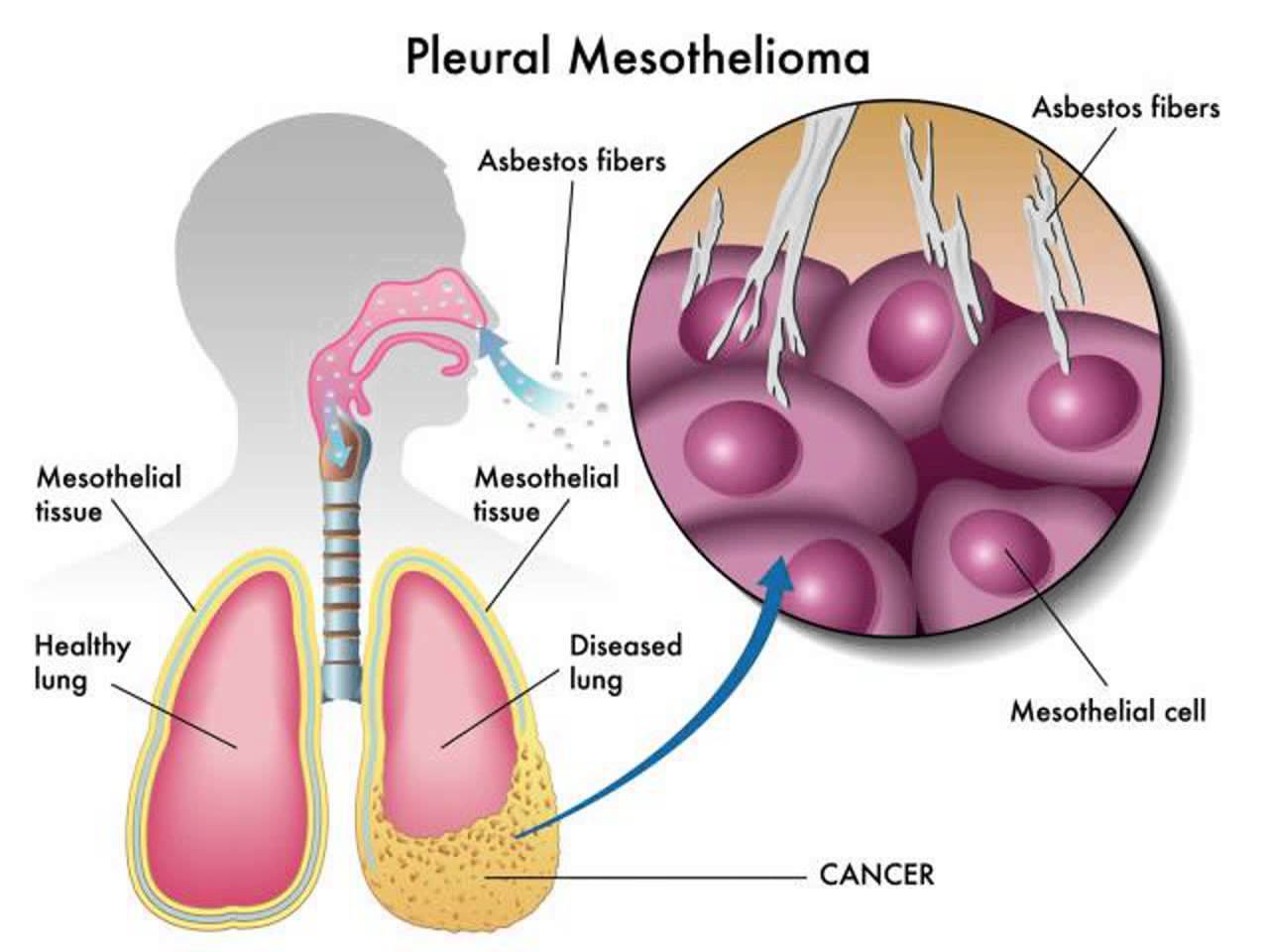 Mesothelioma Lawsuits: Maximizing Compensation Strategies