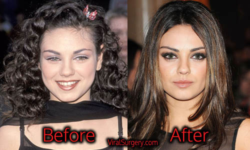 Mila Kunis' Surgery Secrets: Uncovering The Truth