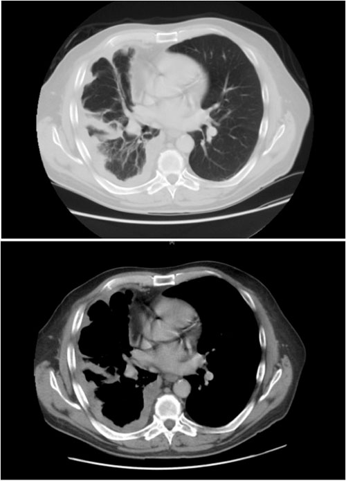 Pleural Mesothelioma Mpm Symptoms Diagnosis Staging Amp Treatment