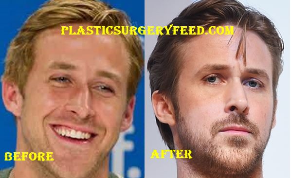 Ryan Gosling Face Surgery