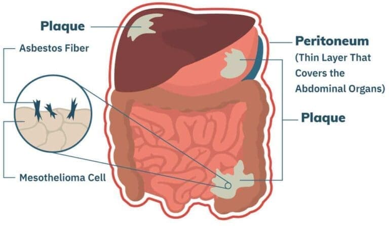 What Are My Legal Options For Mesothelioma In Edinburgh? Get Answers